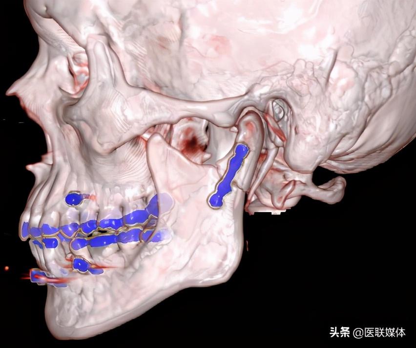 妙手回春，醫(yī)者仁心——六歲萌娃骨折復位實錄